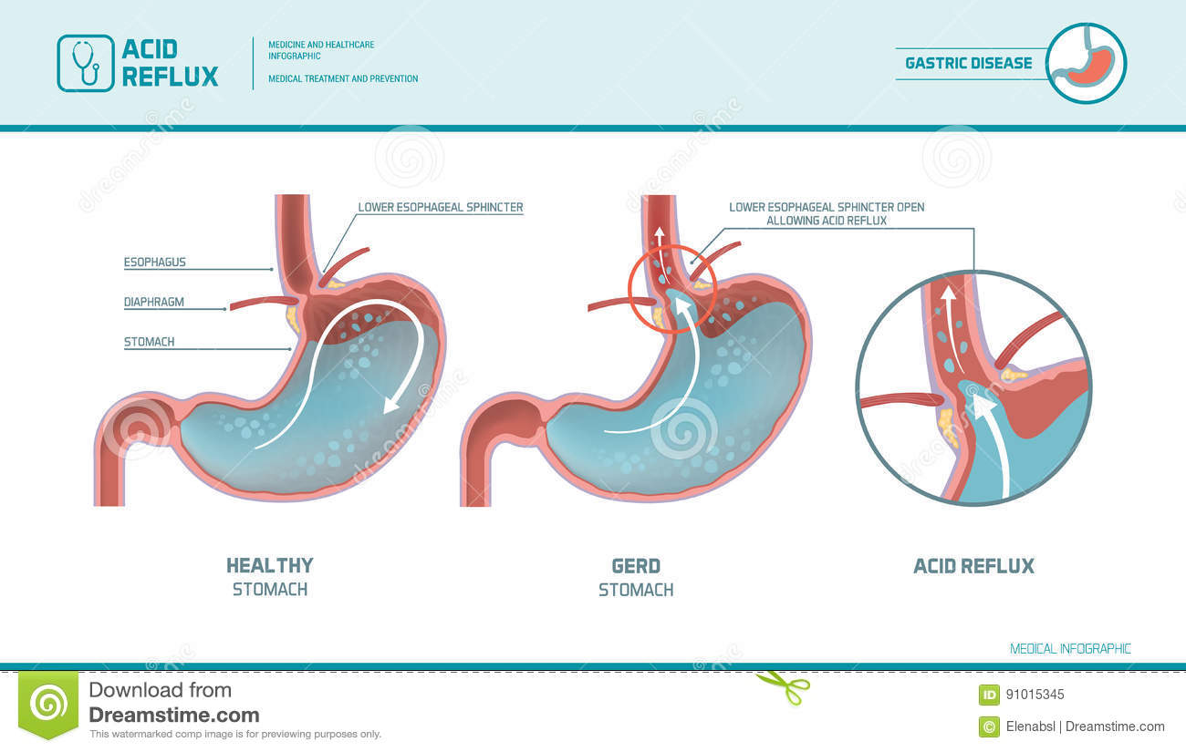 Ameliorer La Vidange Gastrique Traiter Enfin Le Reflux Gastro œsophagien Cles De Sante